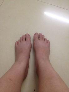 脚肿了的图片,脚部肿胀困扰？揭秘常见原因及缓解方法